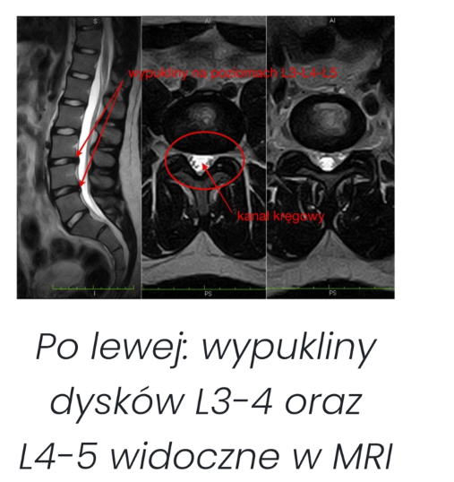 Rezonans magnetyczny kręgosłupa lędźwiowego z wypuklinami L3-L4 i L4-L5, diagnostyka dyskopatii, Poznań