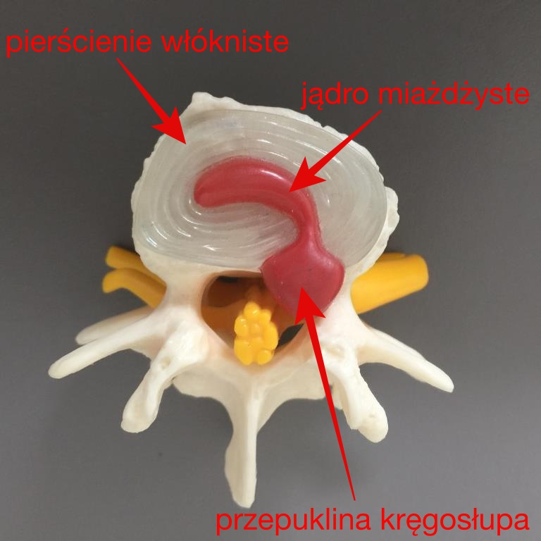 Model kręgu pokazujący pierścień włóknisty, jądro miażdżyste i wypuklinę dysku, chiropraktyka Poznań