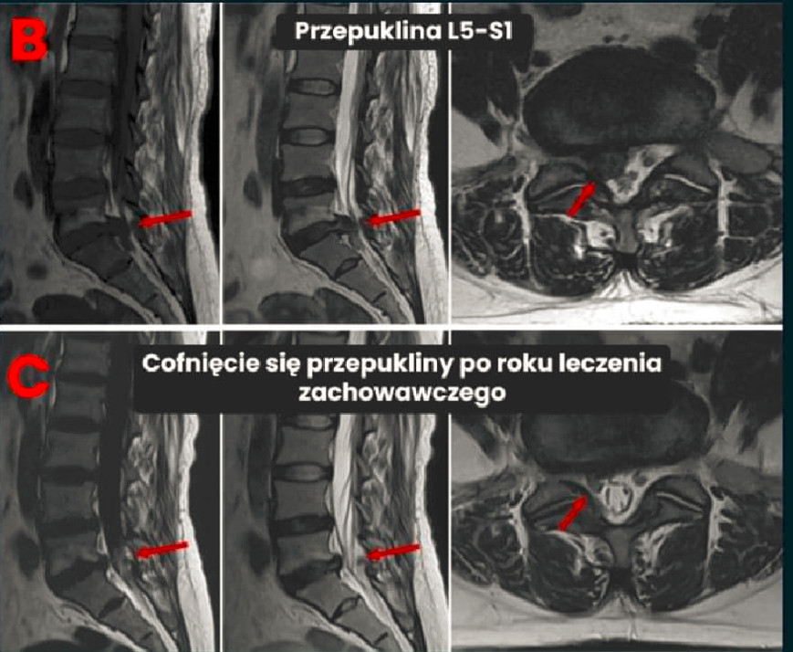 Rezonans magnetyczny: przepuklina L5-S1 przed terapią metodą dr. Coxa i jej cofnięcie po roku postępowania zachowawczego