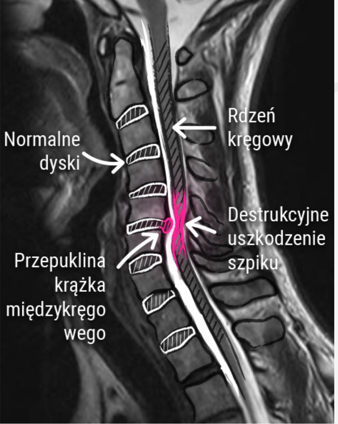 Rezonans kręgosłupa szyjnego z przepukliną krążka uciskającą rdzeń kręgowy, przyczyny bólu głowy, Poznań