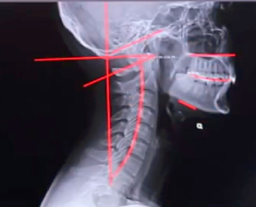 Boczne zdjęcie RTG kręgosłupa szyjnego z liniami analizy lordozy, diagnostyka chiropraktyczna, Poznań