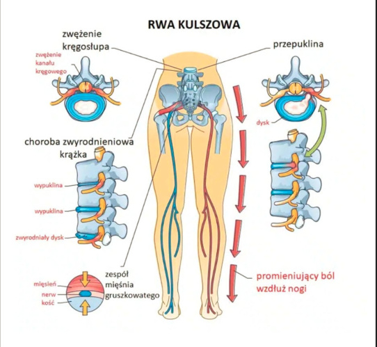 Schemat przyczyn rwy kulszowej: przepuklina, zwężenie kanału, zespół mięśnia gruszkowatego, dyskopatia, Poznań
