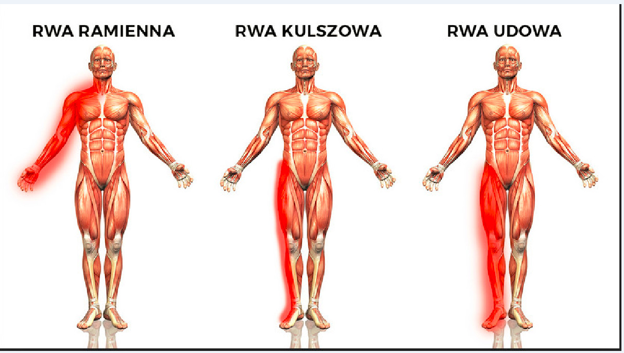 Przebieg bólu przy rwie ramiennej, rwie kulszowej i rwie udowej na sylwetce człowieka, Poznań