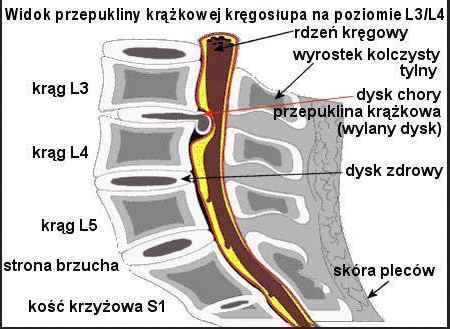 Przekrój kręgosłupa lędźwiowego z przepukliną krążka na poziomie L3-L4 i uciskiem rdzenia, Poznań