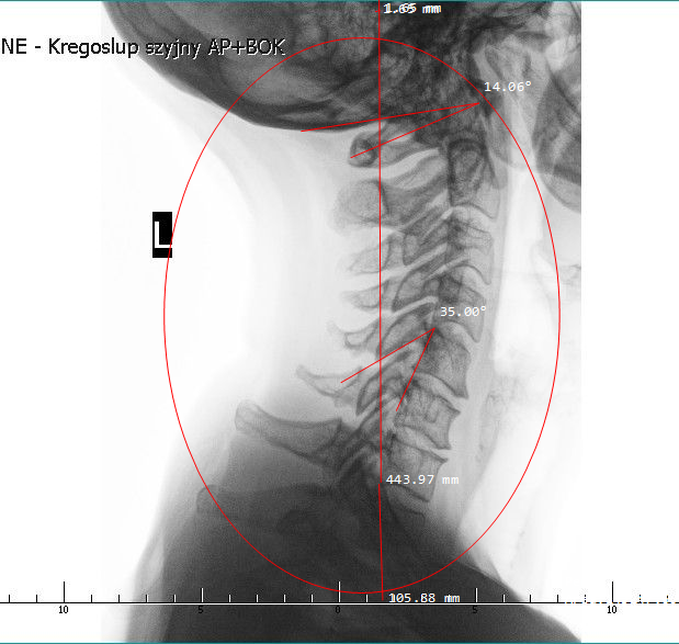 Rozpoznanie i diagnostyka rwy kulszowej w chiropraktyce kręgosłupa