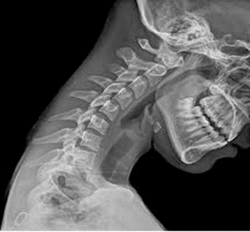 Zdjęcie RTG odcinka szyjnego w wyproście, diagnostyka chiropraktyczna metodą dr. Pierce’a