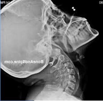 Zdjęcie RTG odcinka szyjnego w zgięciu, diagnostyka chiropraktyczna metodą dr. Pierce’a